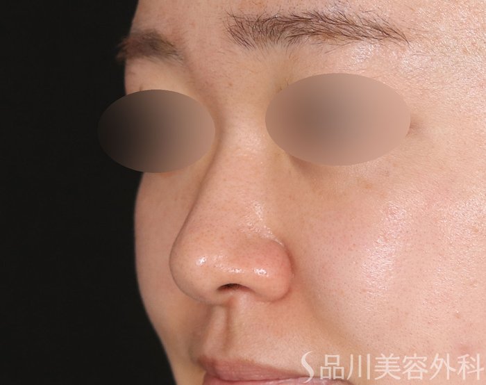 症例NO.73022のBEFORE写真