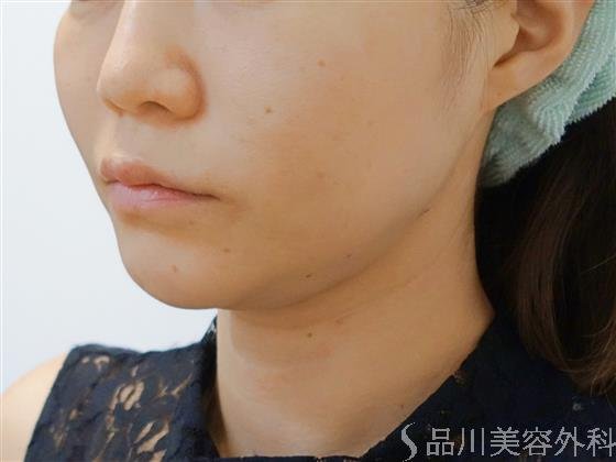 症例NO.36370のBEFORE写真