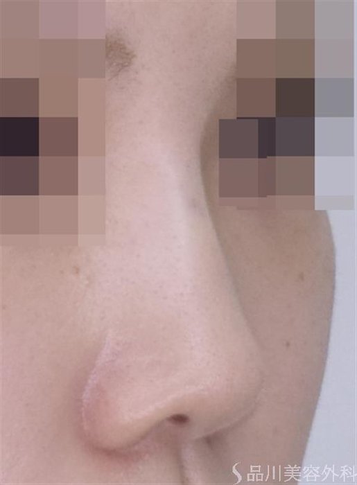 症例NO.50981のAFTER写真