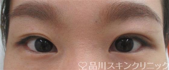 症例NO.26354のBEFORE写真