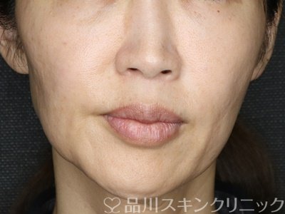 症例NO.71599のBEFORE写真