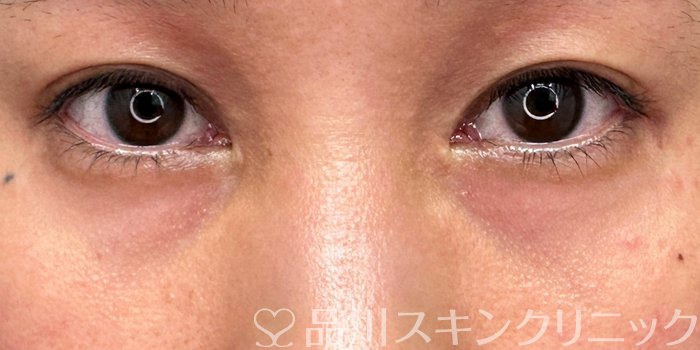 症例NO.70294のBEFORE写真