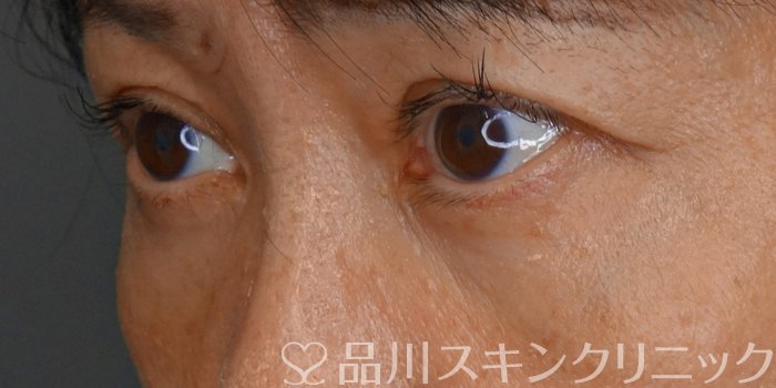 症例NO.71475のBEFORE写真