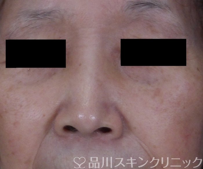 症例NO.70392のBEFORE写真