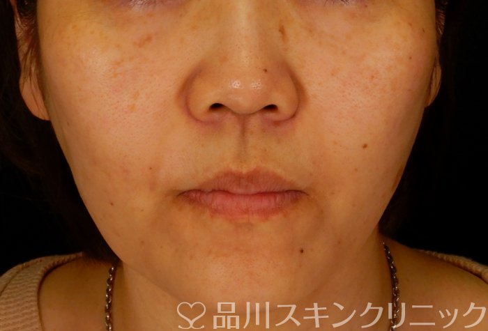 症例NO.62712のAFTER写真