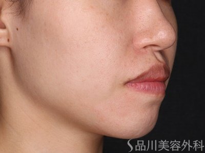 症例NO.73331のAFTER写真