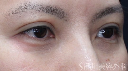 症例NO.71037のAFTER写真