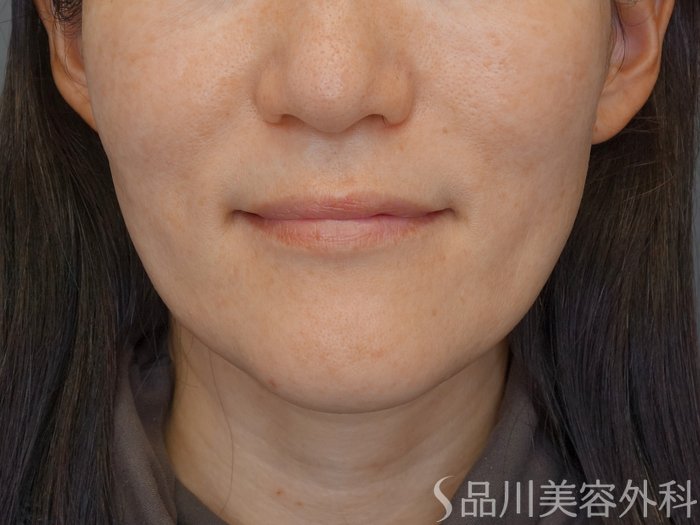 症例NO.72865のBEFORE写真