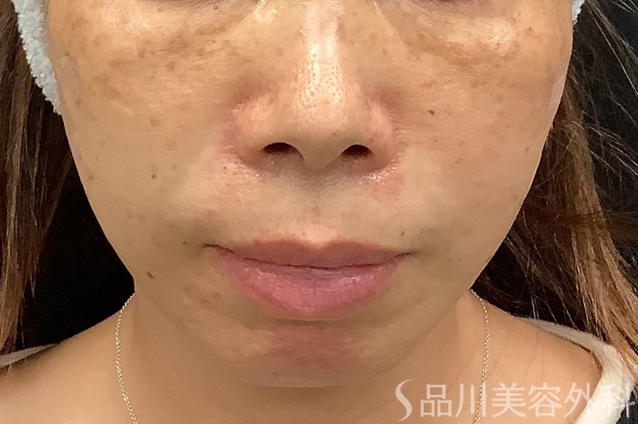 症例NO.67807のAFTER写真