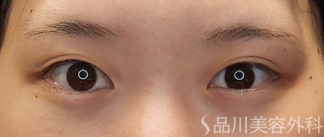 症例NO.71692のBEFORE写真