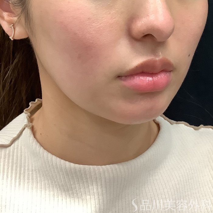 症例NO.75326のBEFORE写真
