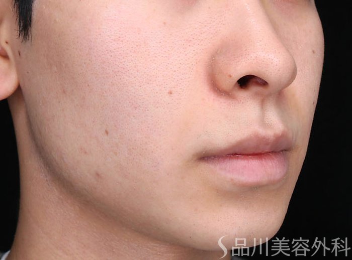 症例NO.72662のAFTER写真