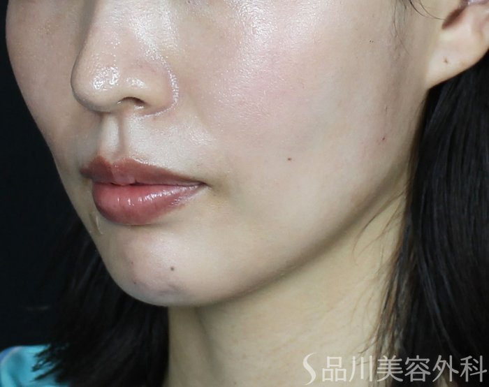 症例NO.70119のAFTER写真