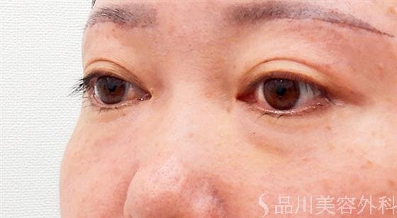症例NO.61763のBEFORE写真