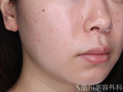 症例NO.71487のBEFORE写真