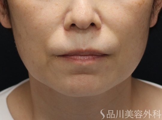 症例NO.74731のBEFORE写真