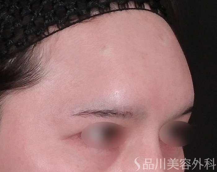 症例NO.69663のAFTER写真