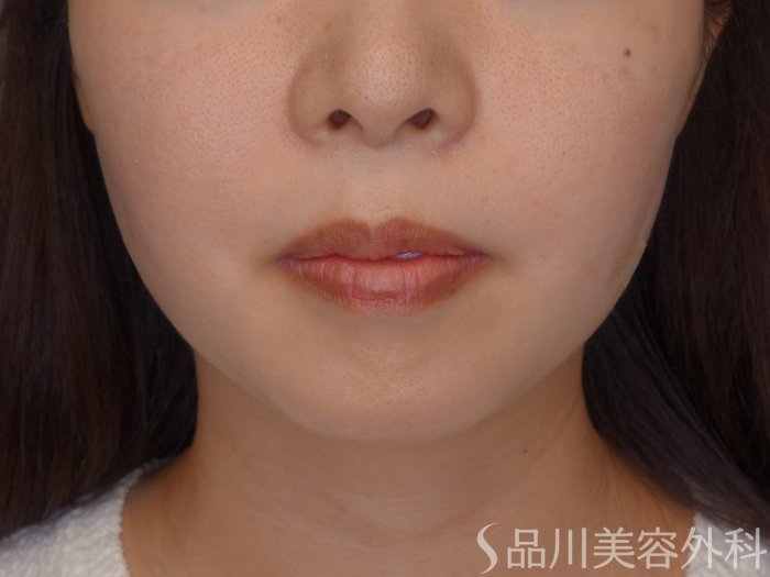 症例NO.71905のAFTER写真