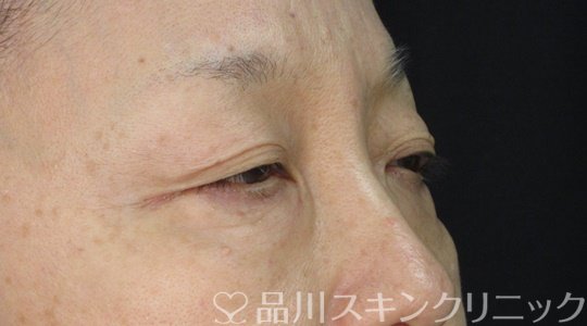 症例NO.72242のBEFORE写真