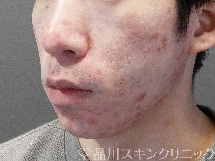 症例NO.69645のBEFORE写真