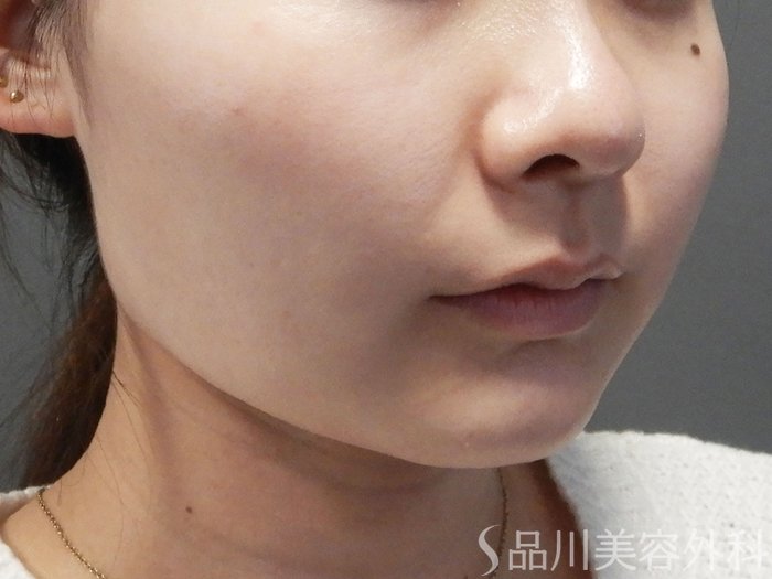 症例NO.70046のAFTER写真