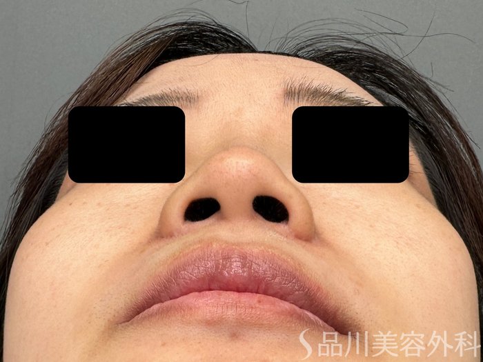 症例NO.74882のBEFORE写真