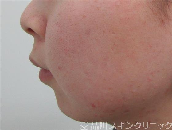症例NO.34648のBEFORE写真