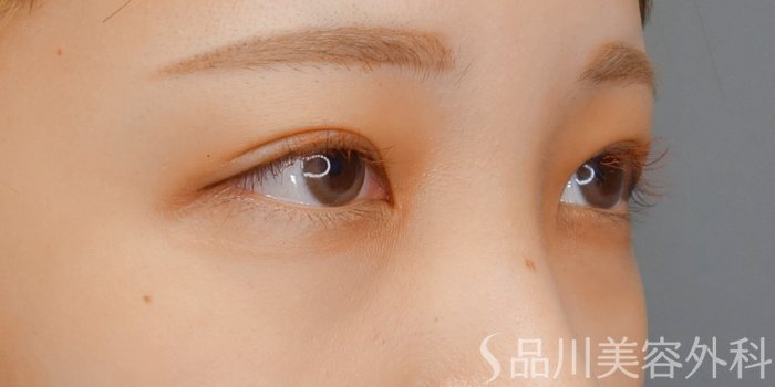 症例NO.73151のAFTER写真