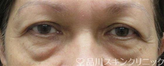 症例NO.61028のBEFORE写真