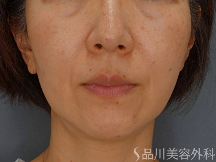症例NO.74231のBEFORE写真