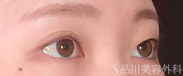 症例NO.70990のBEFORE写真