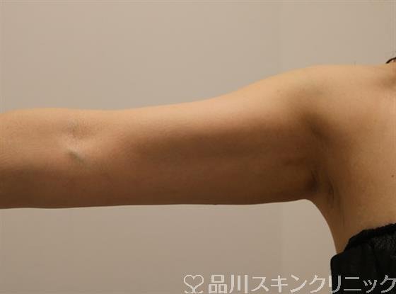 症例NO.44754のAFTER写真