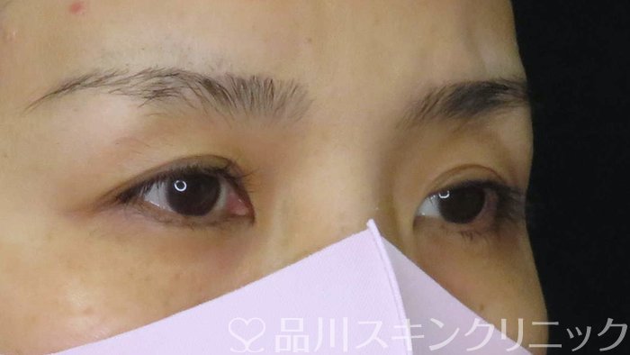 症例NO.62262のBEFORE写真