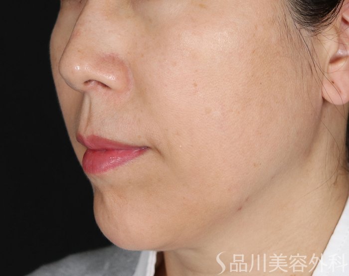 症例NO.72057のBEFORE写真