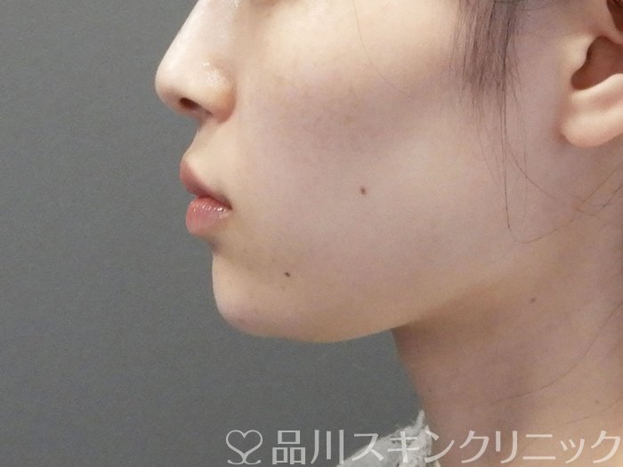 症例NO.70601のAFTER写真
