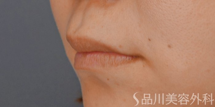 症例NO.71541のBEFORE写真