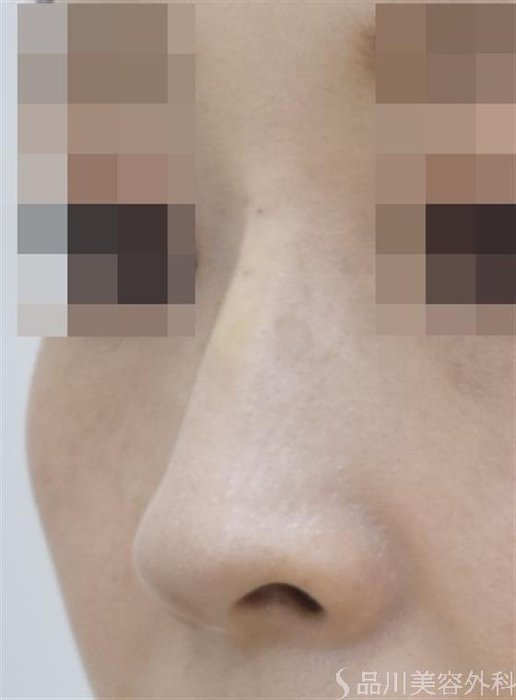 症例NO.47265のAFTER写真