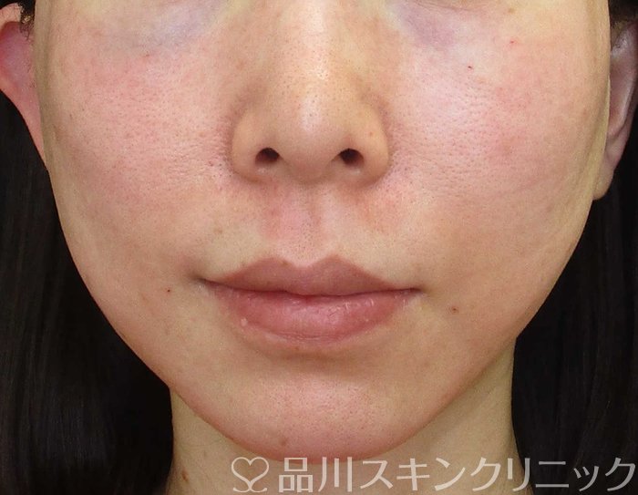 症例NO.65685のAFTER写真