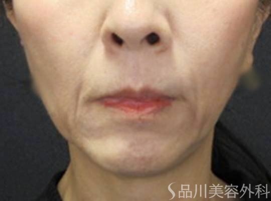 症例NO.72478のBEFORE写真