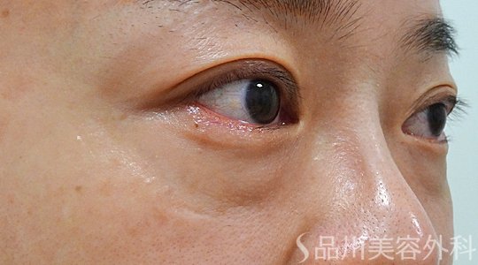 症例NO.73656のBEFORE写真