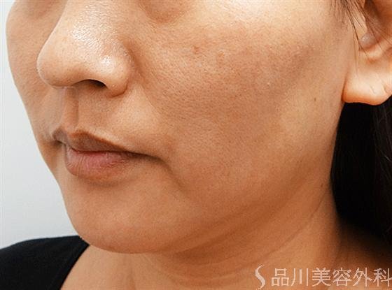 症例NO.14156のAFTER写真