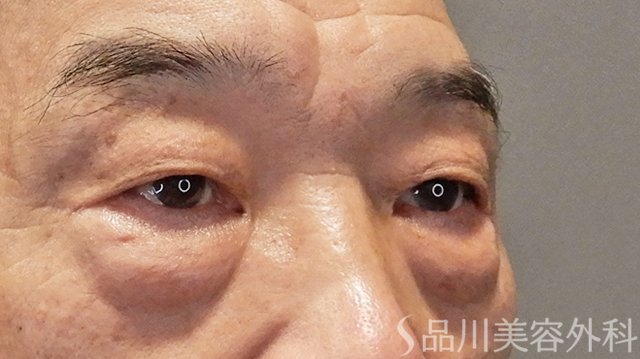 症例NO.75223のBEFORE写真