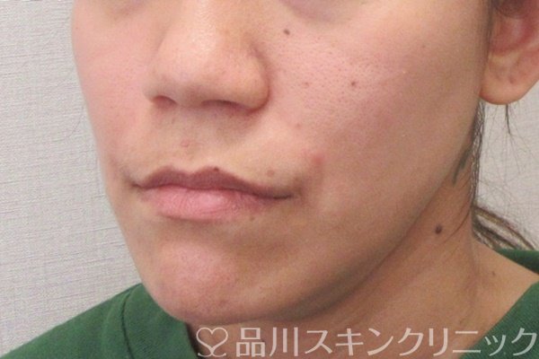 症例NO.70203のAFTER写真
