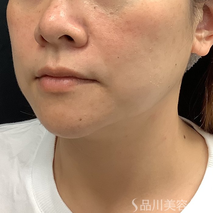 症例NO.75346のBEFORE写真