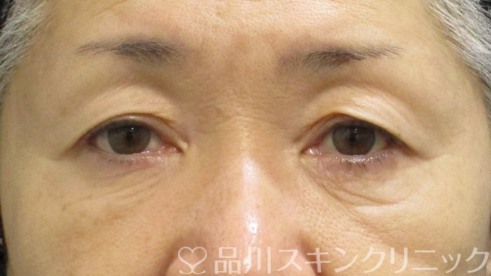 症例NO.69941のAFTER写真