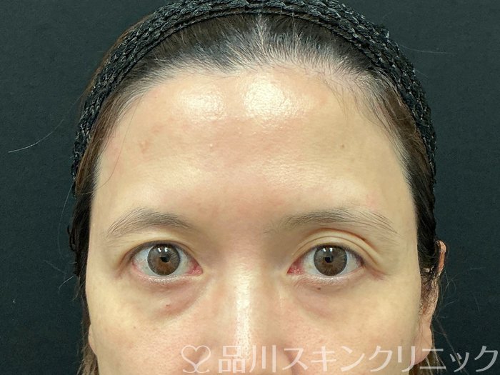 症例NO.75221のBEFORE写真
