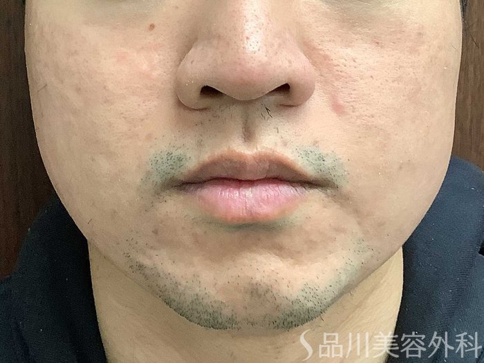 症例NO.62317のBEFORE写真