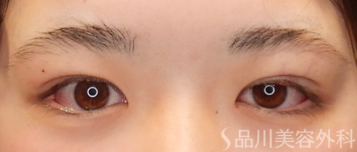 症例NO.69305のAFTER写真