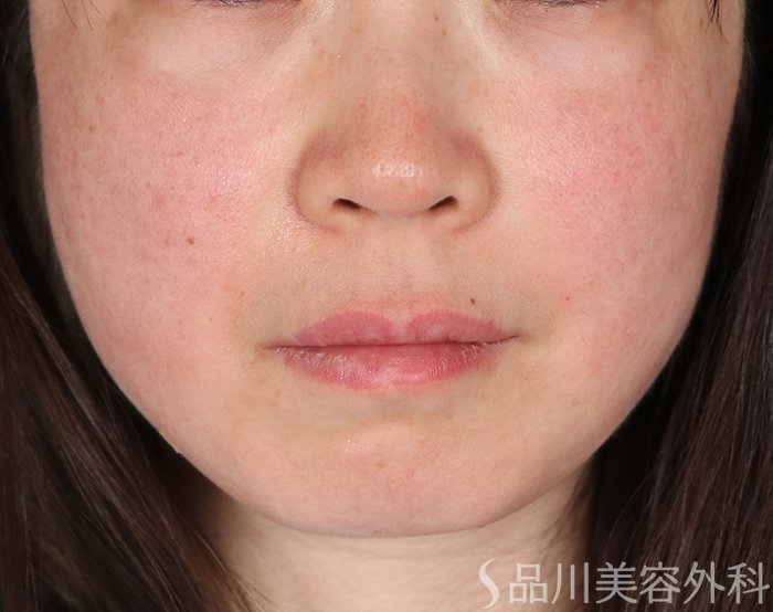 症例NO.72782のAFTER写真