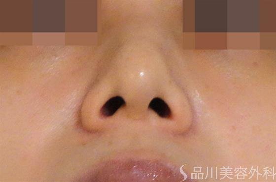症例NO.39186のAFTER写真